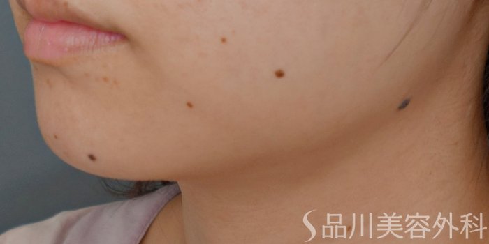 症例NO.72618のBEFORE写真