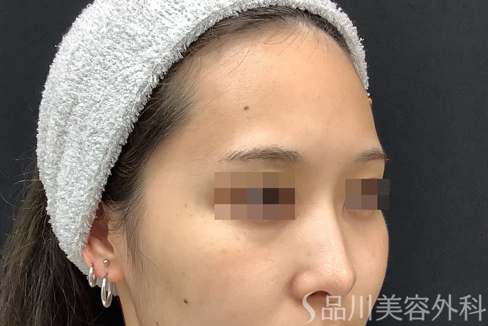 症例NO.67784のBEFORE写真