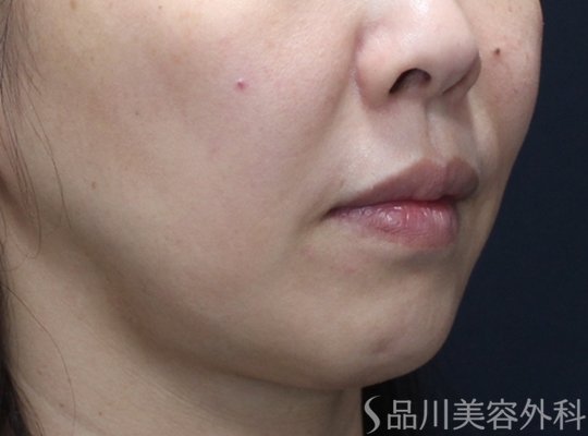 症例NO.74623のBEFORE写真