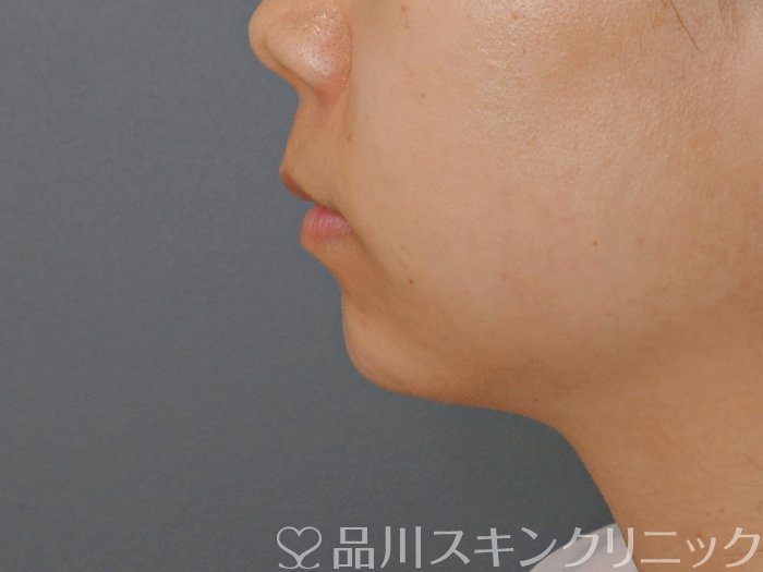 症例NO.71745のAFTER写真