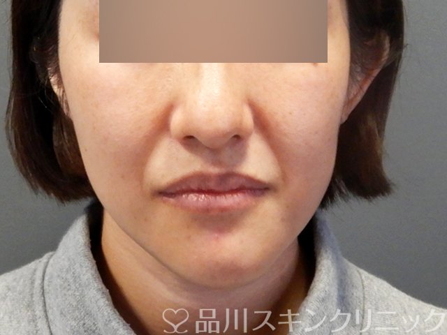 症例NO.69181のBEFORE写真