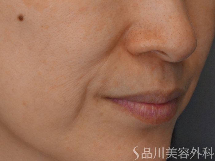 症例NO.71860のBEFORE写真