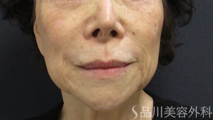 症例NO.64816のBEFORE写真