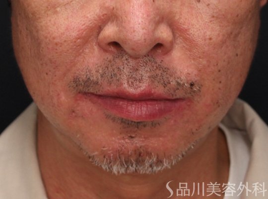 症例NO.72129のAFTER写真