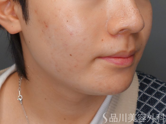 症例NO.69212のAFTER写真