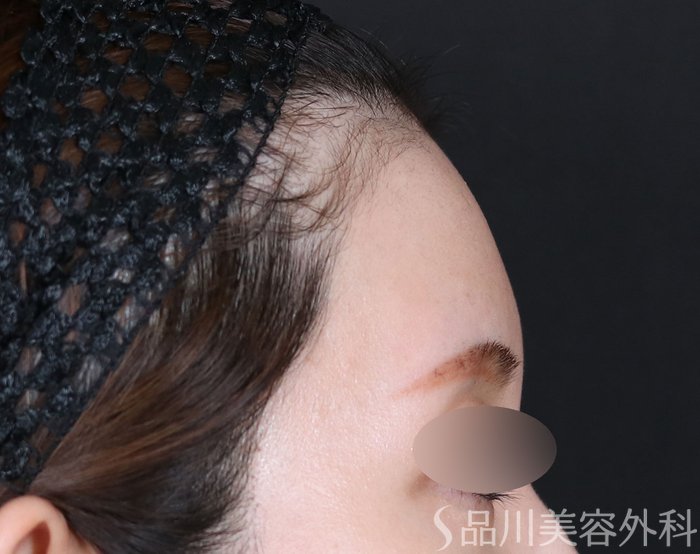 症例NO.71594のBEFORE写真