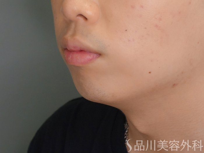 症例NO.70261のBEFORE写真