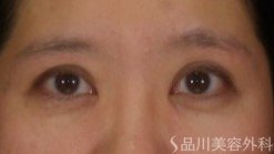 症例NO.72523のAFTER写真