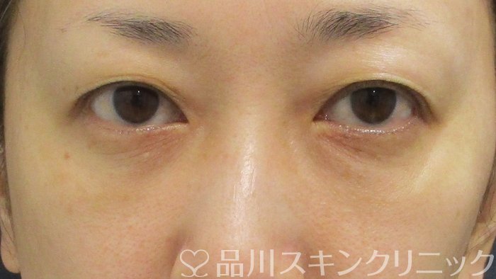 症例NO.74291のAFTER写真