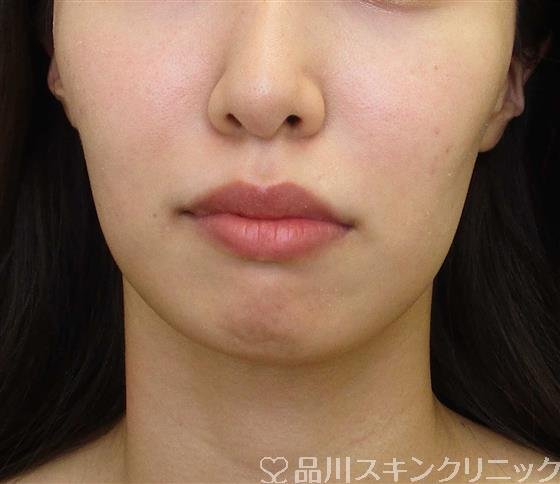 症例NO.58830のBEFORE写真