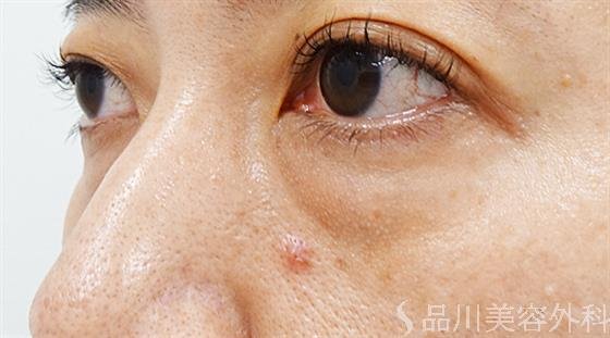 症例NO.48951のBEFORE写真