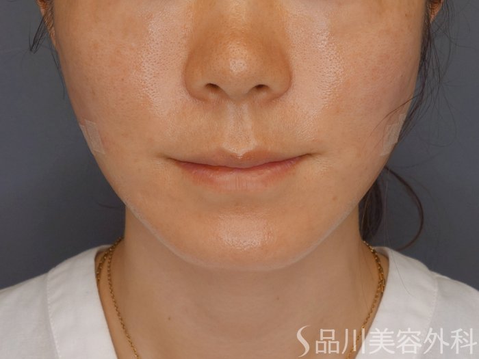 症例NO.72078のAFTER写真