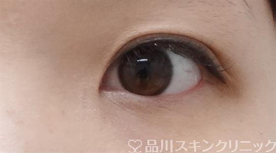 症例NO.28436のAFTER写真