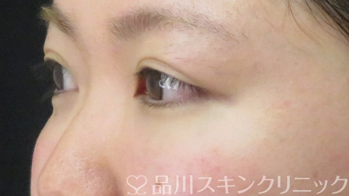症例NO.71171のAFTER写真