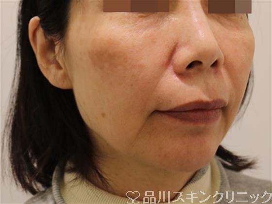 症例NO.40619のBEFORE写真