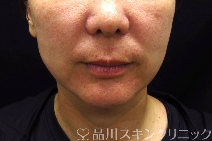 症例NO.74332のBEFORE写真