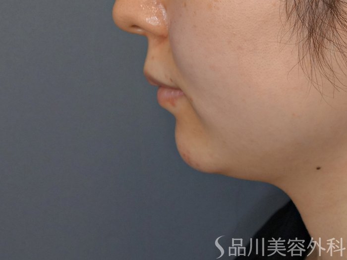 症例NO.72146のBEFORE写真