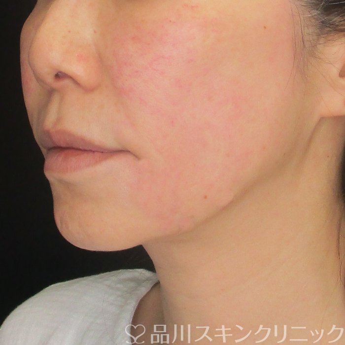 症例NO.73094のAFTER写真