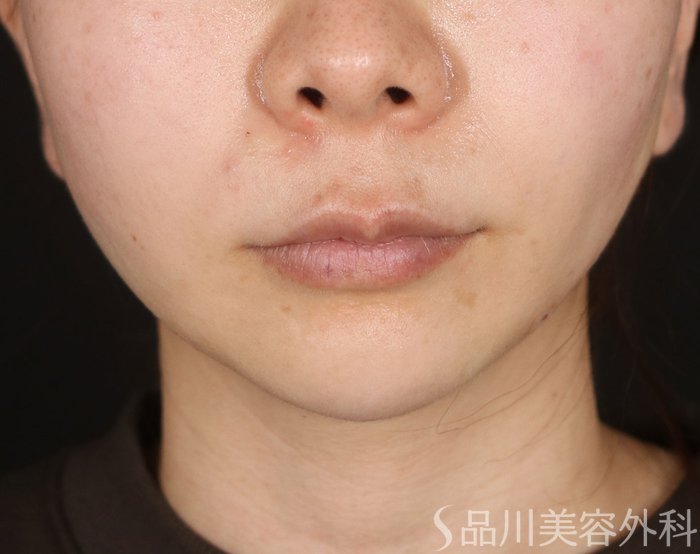 症例NO.73290のAFTER写真