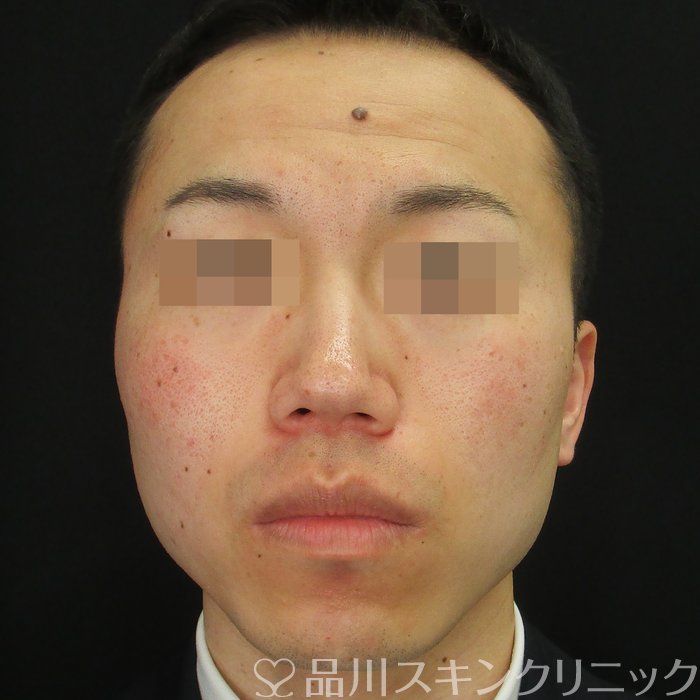 症例NO.74921のBEFORE写真