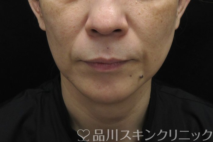 症例NO.74613のBEFORE写真