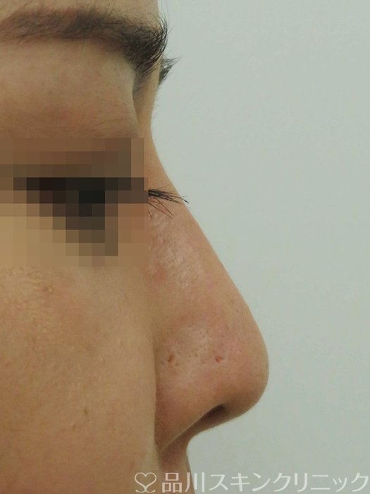 症例NO.71357のBEFORE写真