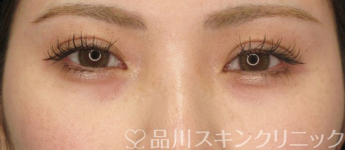 症例NO.69856のAFTER写真