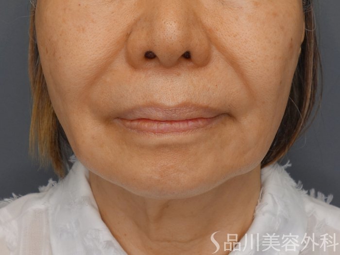 症例NO.70101のBEFORE写真