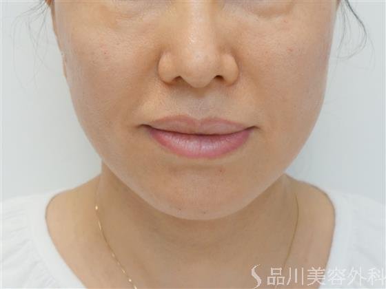 症例NO.38447のAFTER写真