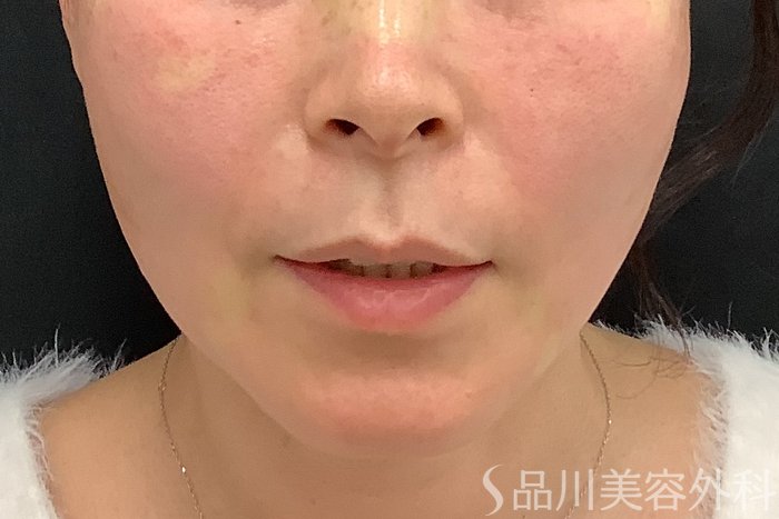 症例NO.73322のAFTER写真