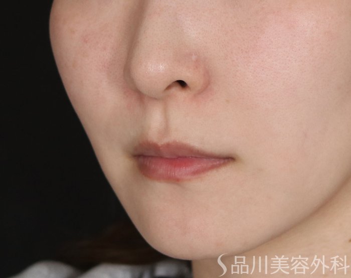 症例NO.72346のBEFORE写真