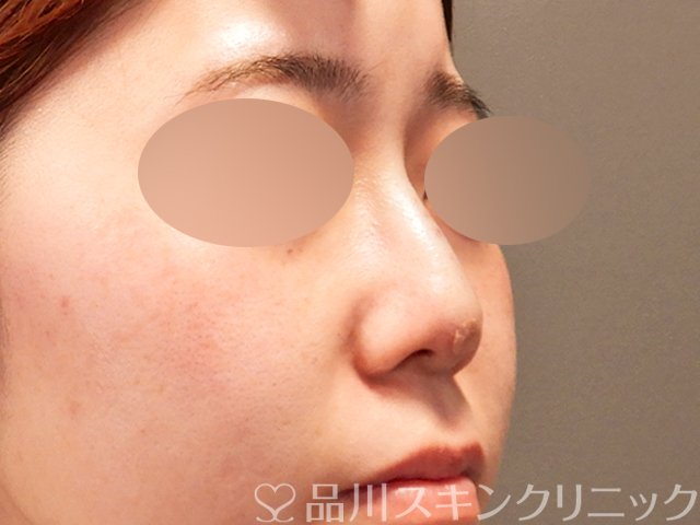 症例NO.71486のAFTER写真