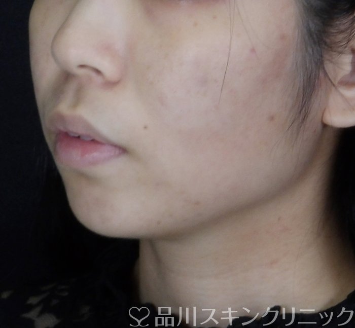 症例NO.67482のAFTER写真