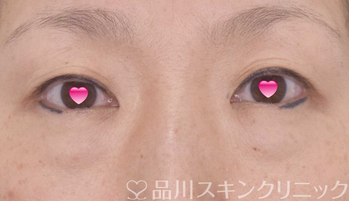 症例NO.69526のBEFORE写真