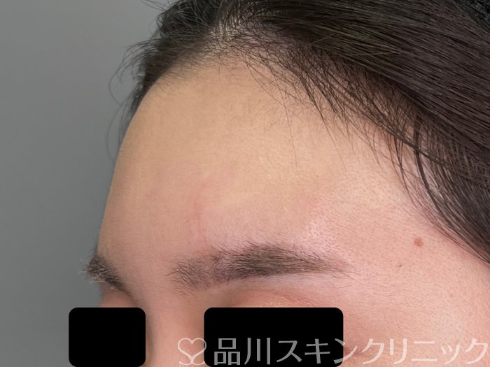 症例NO.69717のAFTER写真