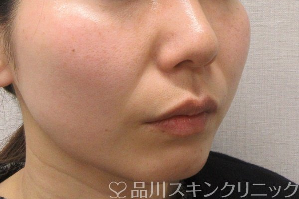 症例NO.69277のBEFORE写真