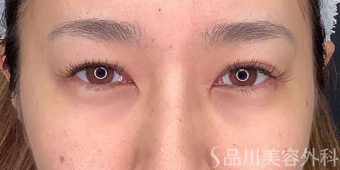 症例NO.71238のBEFORE写真
