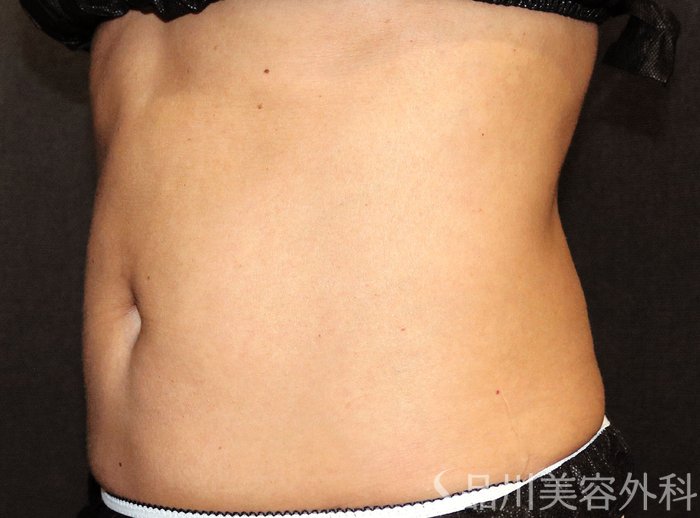 症例NO.72108のAFTER写真