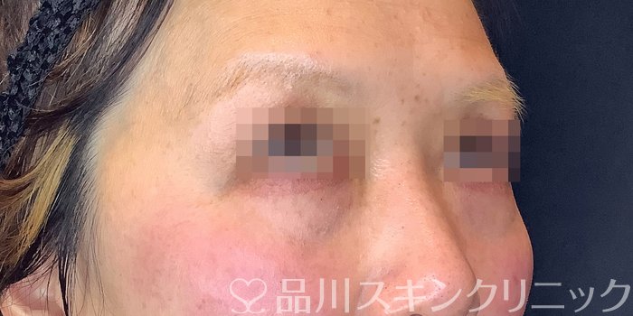 症例NO.71118のBEFORE写真