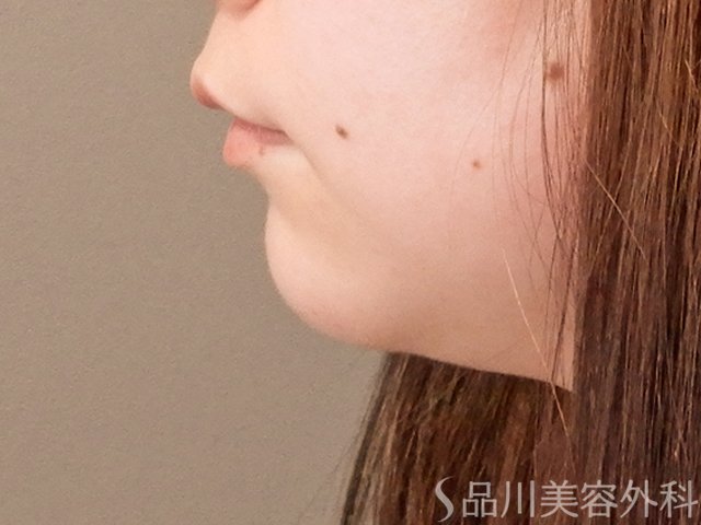 症例NO.70323のBEFORE写真