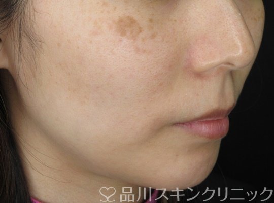 症例NO.70711のBEFORE写真