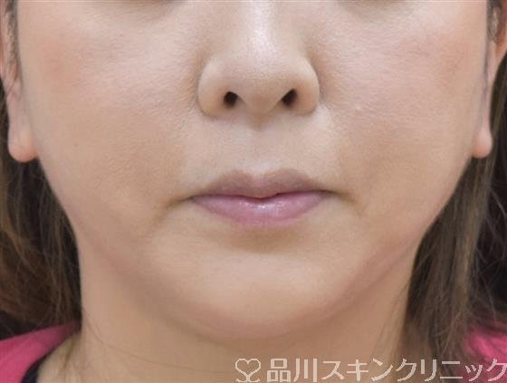 症例NO.58874のAFTER写真