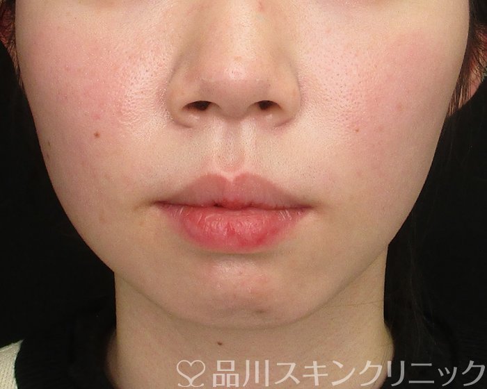 症例NO.69740のBEFORE写真