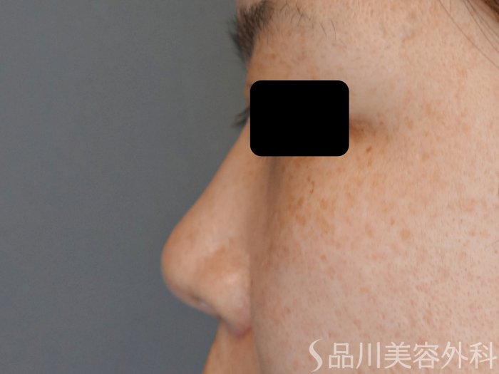 症例NO.71679のBEFORE写真