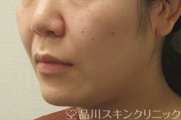 症例NO.74461のBEFORE写真