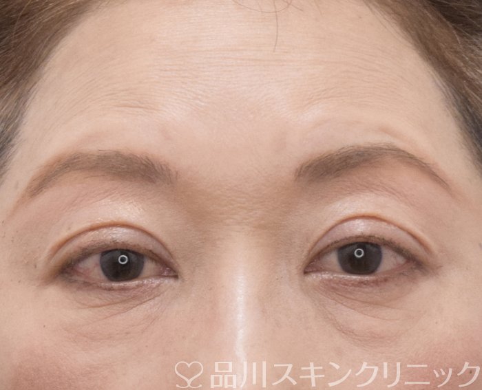 症例NO.74052のAFTER写真