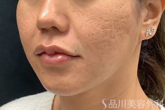 症例NO.73310のAFTER写真