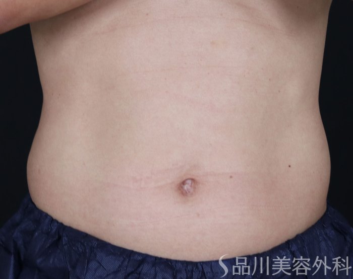 症例NO.73143のBEFORE写真