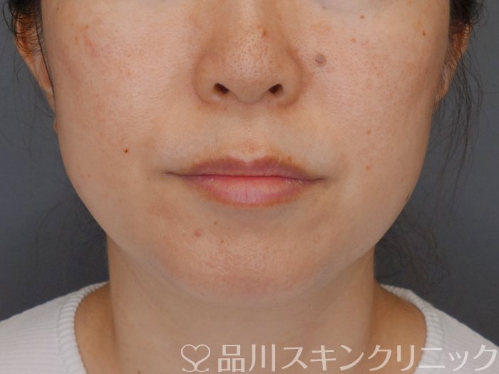 症例NO.71363のBEFORE写真