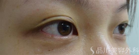 症例NO.25876のBEFORE写真